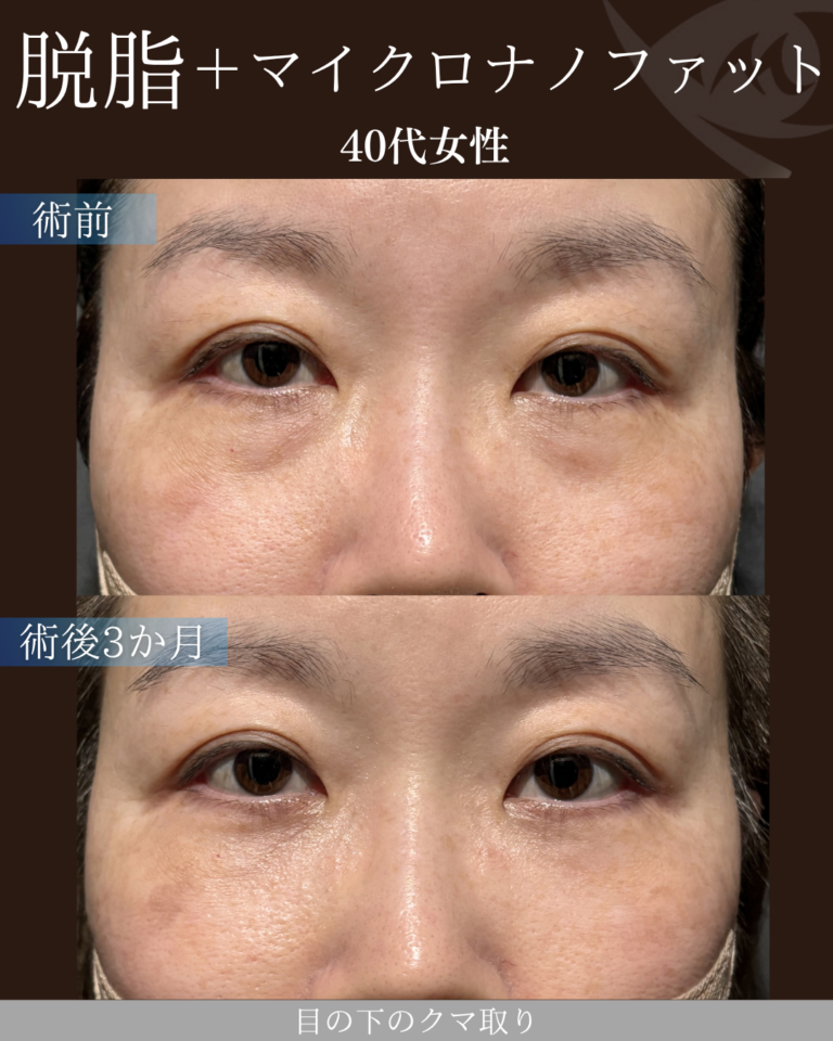 40代女性　脱脂+脂肪注入